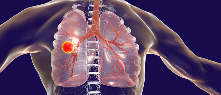 Mrsa — methicillin-resistant staphylococcus aureus