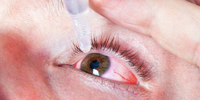 HOW TO TREAT RED EYES FROM SMOKING WEED